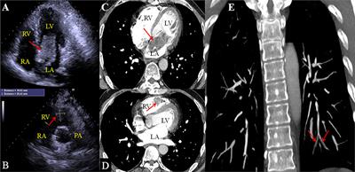 Case Report: Two Myxomas of Different Echodensities on Transthoracic Echocardiography in One Patient